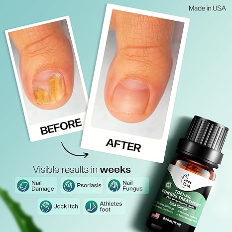 Nail Fungus Treatment – 10ml - Image 5