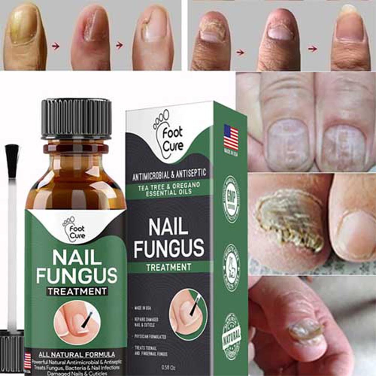 Nail Fungus Treatment – 10ml
